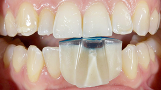 Obnova funkce a estetiky po ztrátě zubních tkání