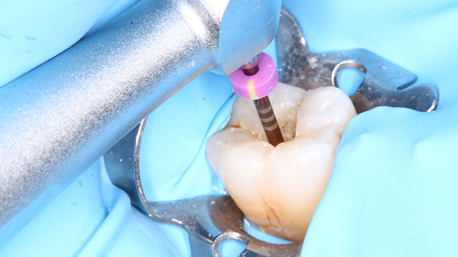 Konzervativní ošetření zubu 46 s nekrózou dřeně, preparace pomocí kořenového nástroje BlueShaper® a obturace pomocí nástroje Z-Condensor®