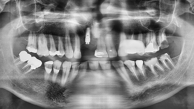 Tajemství aktivního implantátu