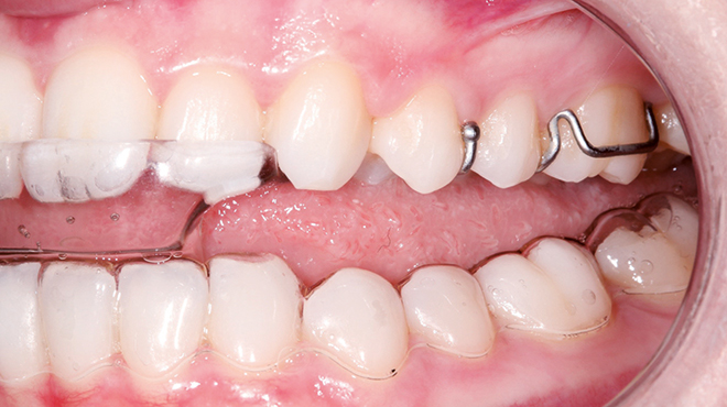 Praktičtí zubní lékaři jsou klíčoví pro diagnostiku a léčbu dysfunkce TMK