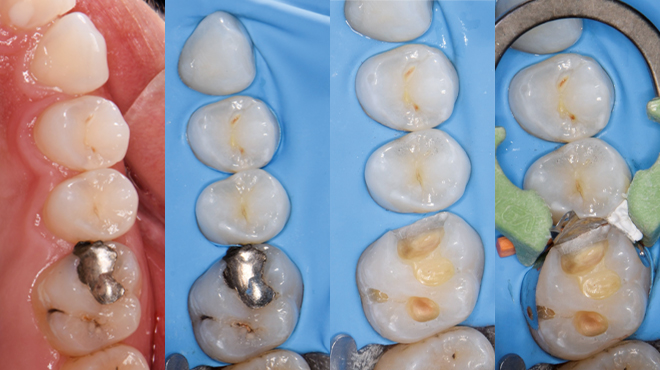 Termoviskózne kompozity VisCalor bulk a VisCalor poskytujú v každodennej stomatológii vynikajúce výsledky