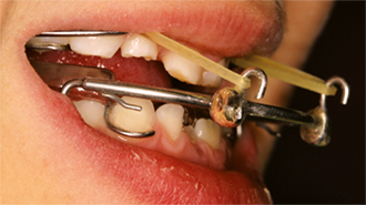 Včasná ortodontická léčba