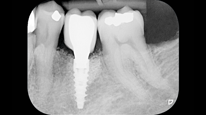 Faktory spojené s designem implantátů, které ovlivňují životnost oseointegrace