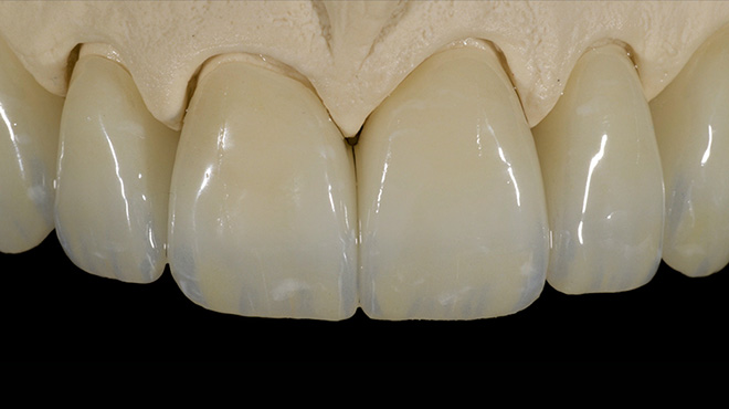 Rekonstrukce horních frontálních zubů pomocí IPS e.max ZirCAD Prime Esthetic