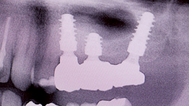 Minimálně invazivní přístup k ošetření pomocí implantátu v distálním úseku horní čelisti Minimálně invazivní přístup k ošetření pomocí implantátu v distálním úseku horní čelisti