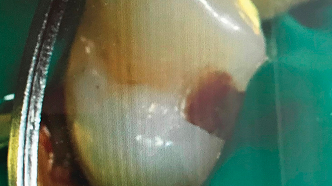 Chemicko-mechanické odstranění infikovaného dentinu při léčbě zubního kazu