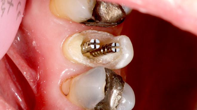 Postendodontické ošetření zubů s použitím titanových čepů Unimetric