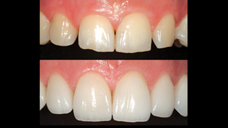 Digitální dentální fotografie – II. část