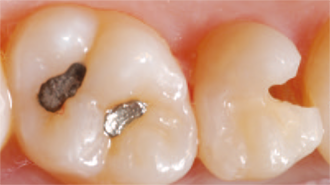Zjednodušení výplňové techniky u distálních zubů díky Admira Fusion x-tra