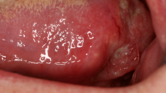 Rozpoznání ohrožených pacientů – tipy na rutinní screening rakoviny dutiny ústní