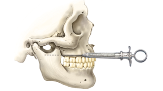 Je „mandibulární anestezie“ minulostí?: Zlepšení úspěšnosti anestezie v dolní čelisti
