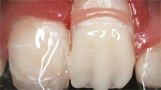 Estetické kompozitní materiály pro zuby a dásně: Rekonstrukce středních řezáků u mladé pacientky