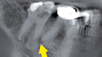 Endodoncie ve 3D – kazuistika s využitím CBCT