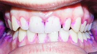 Vliv používání sonického zubního kartáčku na motivaci pacientů k ústní hygieně