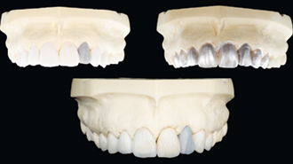 Frontální náhrady na základě zkušebního mock-upu pro vysoce estetický výsledek