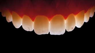 Maximální výzva v estetickém zubním lékařství: korunka na horním středním řezáku