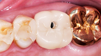 Inteligentní koncept léčby u korunkové náhrady kotvené implantátem