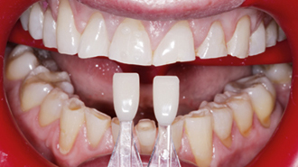 Excelentní výsledek minimálně invazivní rekonstrukce opotřebených zubů – Dahl Concept