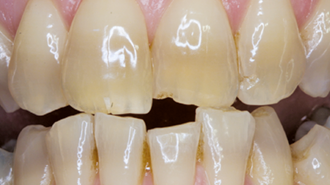 Bělení zubů diskolorovaných tetracyklinem