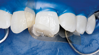 Řešení problémů při zhotovení esteticky přirozených výplní ve frontálních zubech
