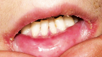 Epidermolysis bullosa congenita v ordinaci dentální hygienistky