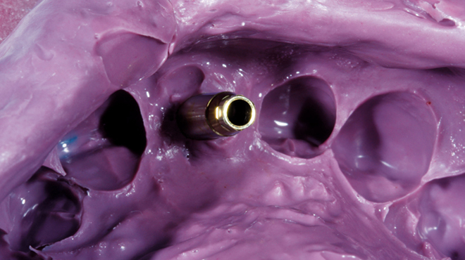 Náhrada frontálního zubu implantátem a korunkou  1. část: Optimální vytvarování měkkých tkání