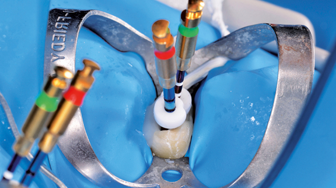 Klinické použití vysoce flexibilních nástrojů pro běžnou i složitější endodonciiNové endodontické nástroje Unicone PLUS