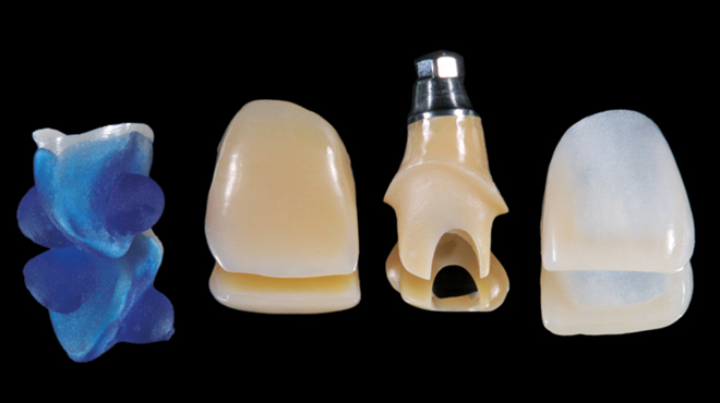 Náhrada frontálního zubu implantátem a korunkou 
