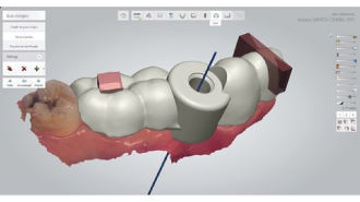 Sólo implantát: Náhrada horního premoláru pomocí digitálního pracovního postupu