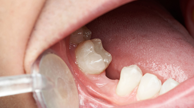 Ztráta zubů by mohla zpomalovat myšlenkové a tělesné funkce