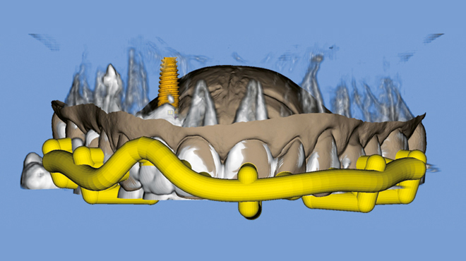 Předoperační digitální plánování monolitických náhrad na implantátech