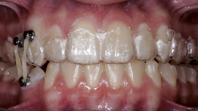 Klinická účinnost léčby Invisalign® s týdenními výměnami ortodontického fóliového aparátu
