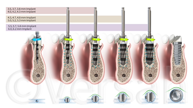 Zvyšování stability implantátu pomocí oseodenzifikace – kazuistika s dvouletým sledováním