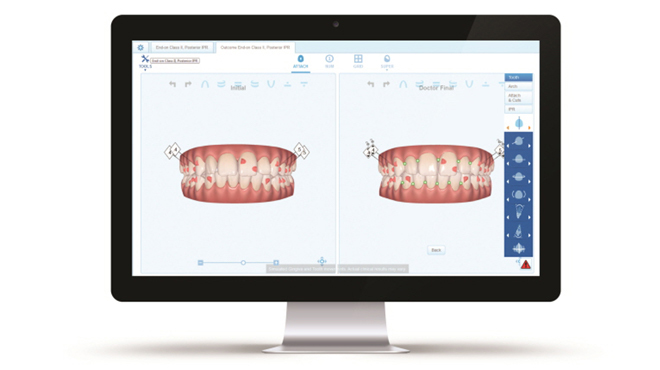 Align Technology rozšiřuje digitální platformu o cloudovou vizualizaci pro léčbu Invisalign ClinCheck™ Pro 6.0 a ClinCheck “In-Face” Visualization