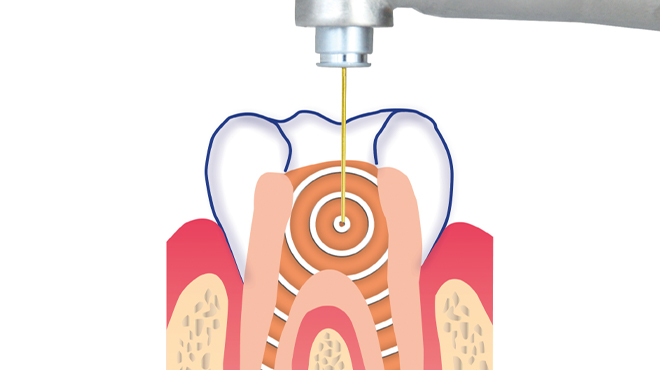 SSP/SWEEPS endodoncie se SkyPulse Er:YAG laserem