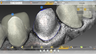 Intraorální skener Apollo DI a portál CEREC Connect v denní praxi