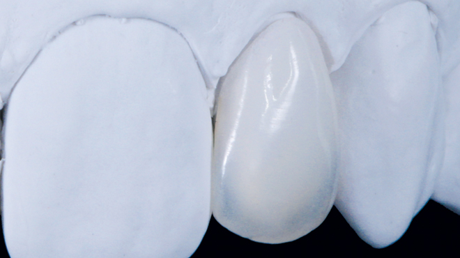 Úprava estetiky čípkovitého zubu pomocí minimálně invazivní keramické fazety