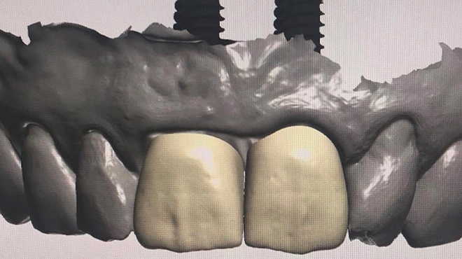 Navigovaná chirurgia v našej praxi – súčasná digitálna stomatológia