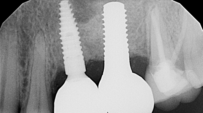 Společné využití titanových a zirkonových implantátů