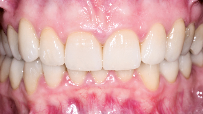 Celokeramické korunkové náhrady pro rekonstrukci poškozené zubní skloviny