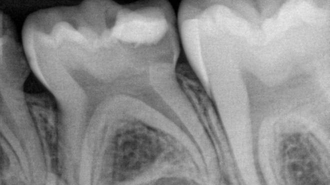 Klinické použití Biodentine™ při pulpotomiích u frontálních a distálních dočasných zubů