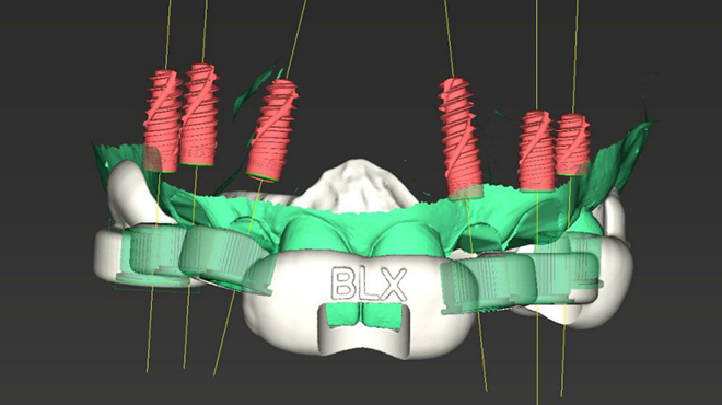 Digitálně zhotovená okamžitá celková fixní náhrada nesená implantáty Straumann® BLX ø 3,75, krátkými distálními implantáty