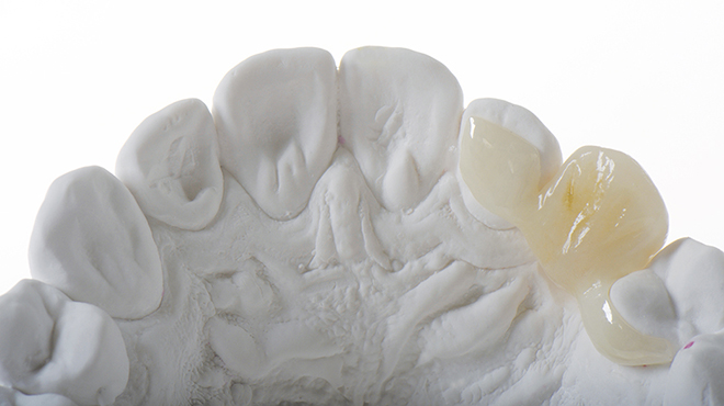 The Zirconia Resin Bonded Bridge (RBB)