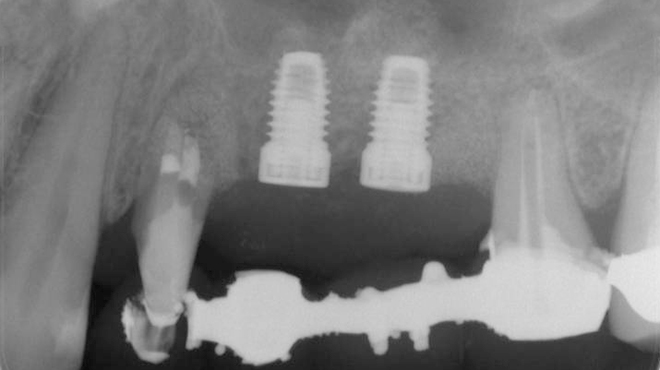 Endodonticko-parodontologická léčba pilířového zubu