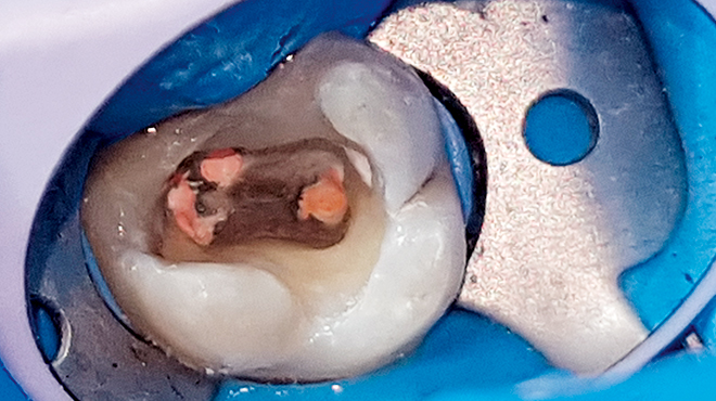 Nechirurgický management maxilární sinusitidy endodontického původu
