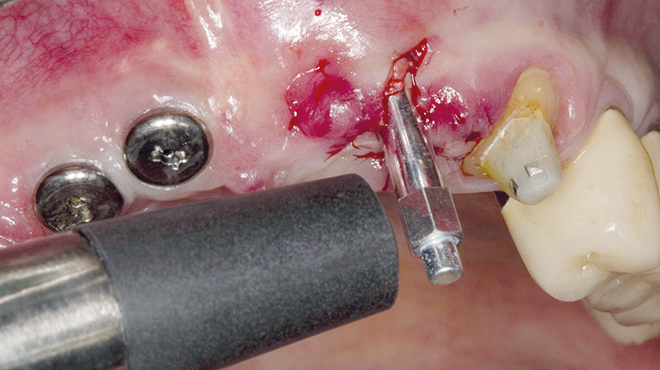 Implantáty v kombinaci s řízenou regenerací kosti pro zirkonový můstek ve frontálním úseku horní čelisti