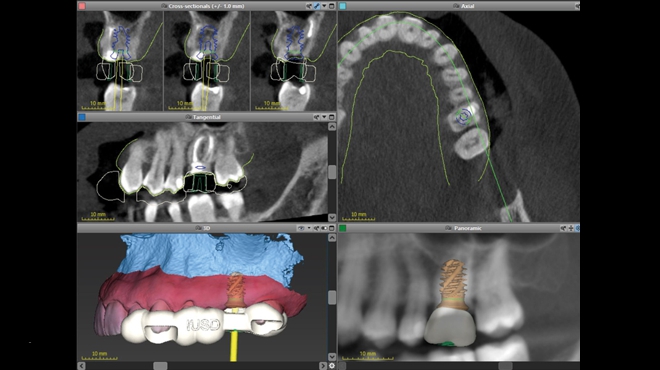 Straumann® TLX implantát a okamžitá náhrada jednoho moláru v horní čelisti