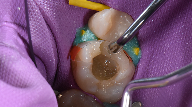 Rekonstrukce endodonticky ošetřených zubů pomocí techniky dvouvrstvého nanášení kompozitu