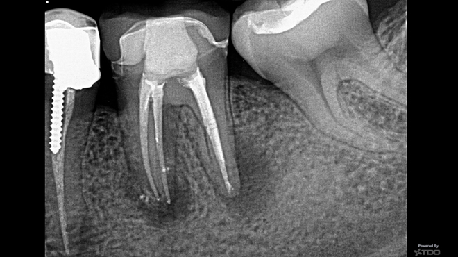 Popření tří největších mýtů v endodoncii