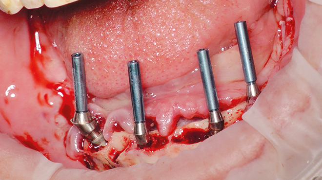 Implantáty s konometrickým spojem zjednodušují postup „ALL-ON-FOUR“